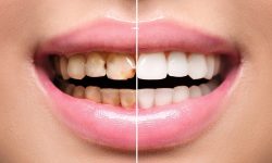تاریخچه و تحولات لمینت دندان