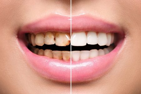 تاریخچه و تحولات لمینت دندان